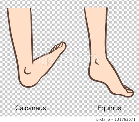足関節の変形、踵足と尖足 131762671