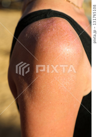 Close-up of Peeling Skin on a Woman's Body Due to Sunburn, Highlighting the Effects of Overexposure to Sunlight and Skin Damage 131765108