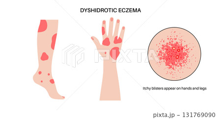 Dermatitis skin disease 131769090
