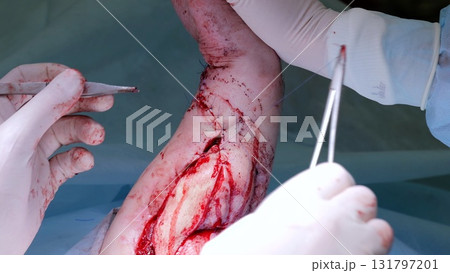 Surgical team performing meticulous wound closure, carefully suturing deep leg incision with professional medical precision during critical operative procedure 131797201