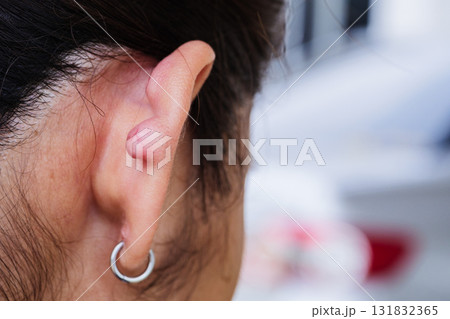 Skin tags understanding causes treatments and prevention everyday life Skin tags understanding causes treatments and prevention everyday life 131832365