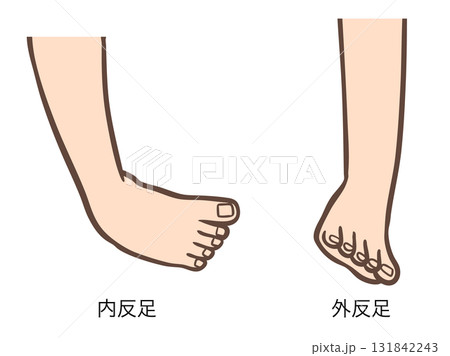 足部の変形、内反足と外反足のイラスト01 131842243