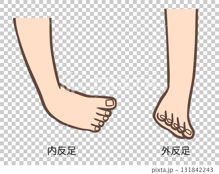 Foot deformity, illustration of clubfoot and valgus foot 01 131842243