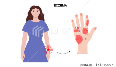 Dermatitis skin disease 131850097