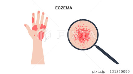 Dermatitis skin disease 131850099