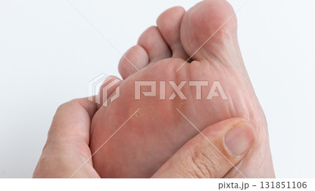 Close-up of a hand gently pressing on a foot with corns and calluses, highlighting foot health and care in a clean, bright environment 131851106