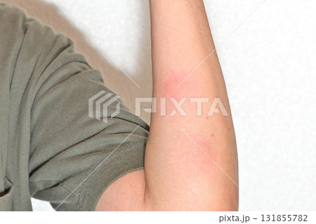 蚊に刺された腕 蚊に刺された腕 131855782