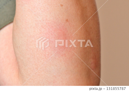 蚊に刺された腕 131855787