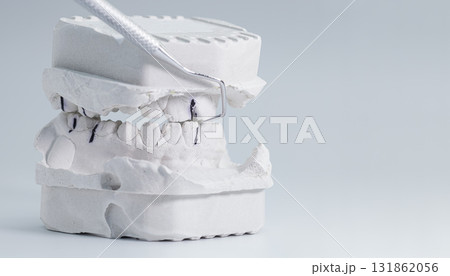 Dental plaster model with marked occlusion points 131862056