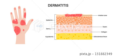 Dermatitis skin disease 131882349