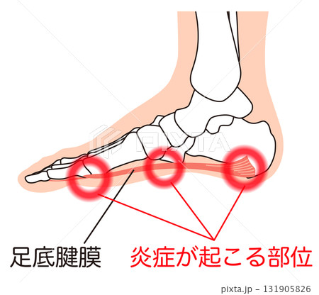 足底筋膜 足底腱膜 足底筋膜炎 足の筋肉 足底筋膜 足底腱膜 足底筋膜炎 足の筋肉 131905826