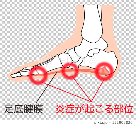 足底筋膜 足底腱膜 足底筋膜炎 足の筋肉 足底筋膜 足底腱膜 足底筋膜炎 足の筋肉 131905826