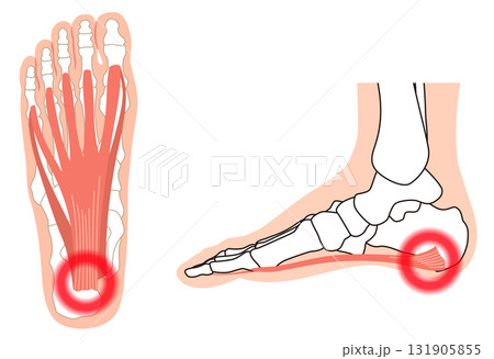 足底筋膜　足底腱膜　足底筋膜炎　足の筋肉 131905855