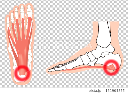 足底筋膜　足底腱膜　足底筋膜炎　足の筋肉 131905855