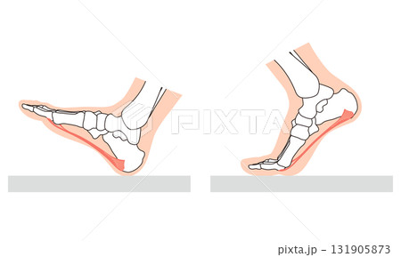 足底筋膜炎 足底筋膜 足底腱膜 足の筋肉 足底筋膜炎 足底筋膜 足底腱膜 足の筋肉 131905873