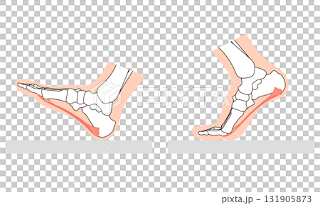足底筋膜炎 足底筋膜 足底腱膜 足の筋肉 足底筋膜炎 足底筋膜 足底腱膜 足の筋肉 131905873