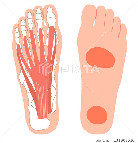 足底筋膜炎　痛みの出やすい場所　足底筋膜　足底腱膜 131905910