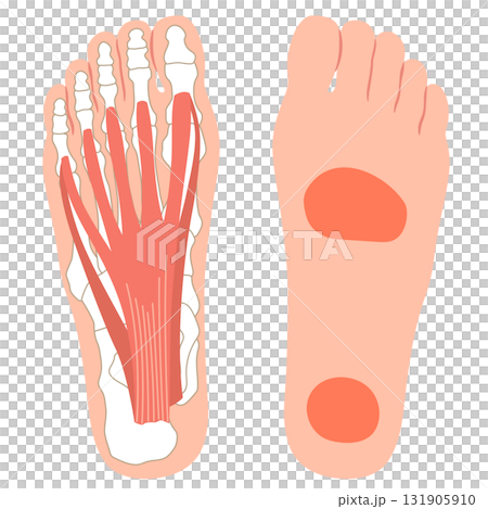 足底筋膜炎　痛みの出やすい場所　足底筋膜　足底腱膜 131905910