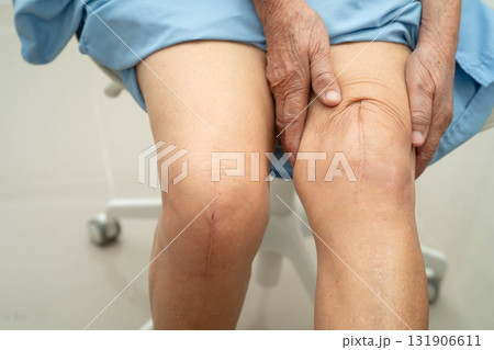 Asian elderly woman patient with scar knee replacement surgery in hospital. Asian elderly woman patient with scar knee replacement surgery in hospital. 131906611