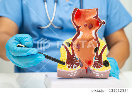 Asian doctor with rectum and hemorrhoid human anatomy model at hospital, inflamed vascular structure. 131912584