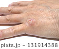 手の皮膚病　アレルギー　体質 131914388