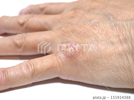 手の皮膚病　アレルギー　体質 131914388