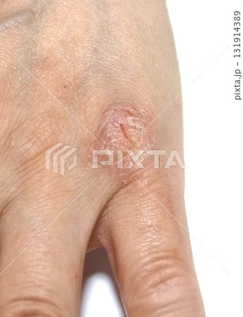 手の皮膚病 131914389