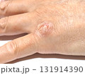 手の皮膚病 131914390