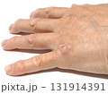 手の皮膚病 131914391