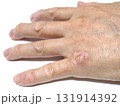 手の皮膚病 131914392