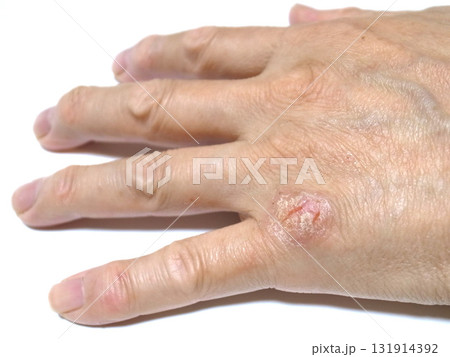 手の皮膚病 手の皮膚病 131914392