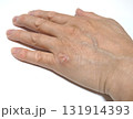 手の皮膚病 131914393