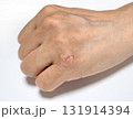 手の皮膚病 131914394