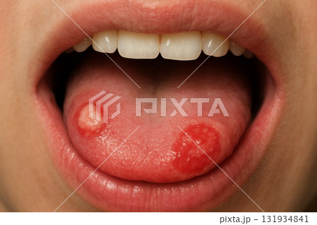 口腔粘膜疾患（口内炎・良性腫瘍・舌の出来物） 131934841