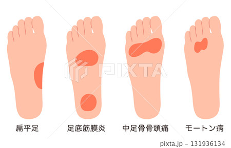 足裏の痛み 炎症が起きる箇所 足裏の痛み 炎症が起きる箇所 131936134