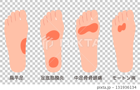 足裏の痛み 炎症が起きる箇所 足裏の痛み 炎症が起きる箇所 131936134