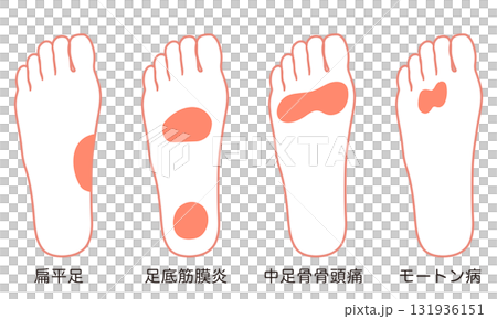 足裏の痛み　炎症が起きる箇所 131936151