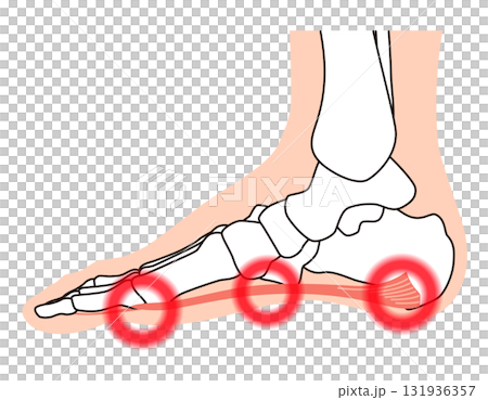 Plantar fascia, plantar aponeurosis, plantar fasciitis, foot muscles 131936357