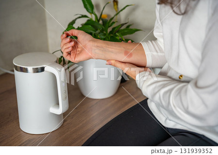Scald burn on a hand caused by steam from a kettle in a kitchen. Domestic accident illustrating the danger of hot appliances. Scald burn on a hand caused by steam from a kettle in a kitchen. Domestic accident illustrating the danger of hot appliances. 131939352