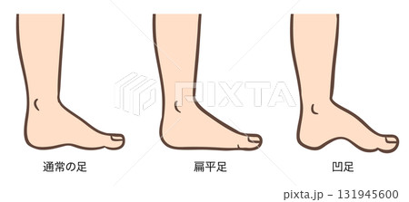 足の変形、正常な足、扁平足、凹足のイラストセット01 足の変形、正常な足、扁平足、凹足のイラストセット01 131945600