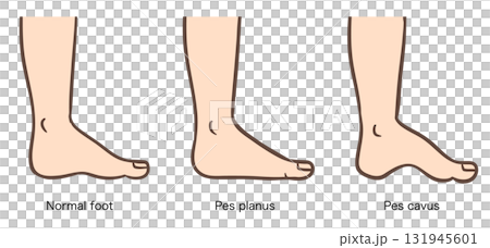 Foot deformity, normal foot, flat foot, cavus foot illustration set 02 131945601