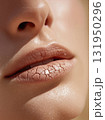 Dry Cracked Lips and Skin 131950296