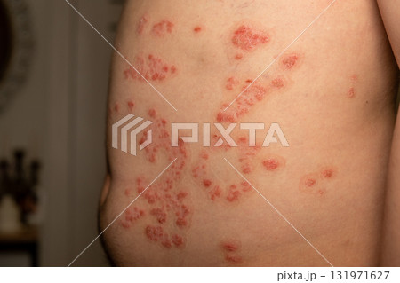 Red, scaly skin patches on the abdomen highlight the symptoms of psoriasis in a light filled indoor setting, displaying itchiness and discomfort. Red, scaly skin patches on the abdomen highlight the symptoms of psoriasis in a light filled indoor setting, displaying itchiness and discomfort. 131971627