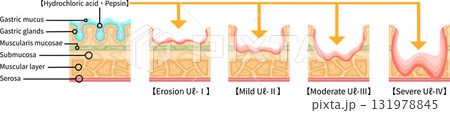胃潰瘍 重症度 イラスト 英語 胃潰瘍 重症度 イラスト 英語 131978845