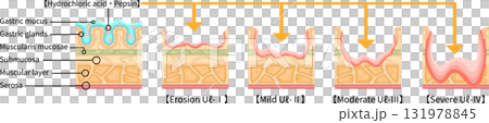 胃潰瘍 重症度 イラスト 英語 胃潰瘍 重症度 イラスト 英語 131978845