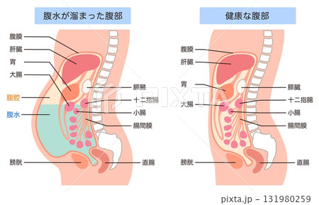 腹水が溜まった腹部と、健康な腹部 腹水が溜まった腹部と、健康な腹部 131980259