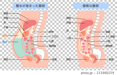腹水が溜まった腹部と、健康な腹部 腹水が溜まった腹部と、健康な腹部 131980259
