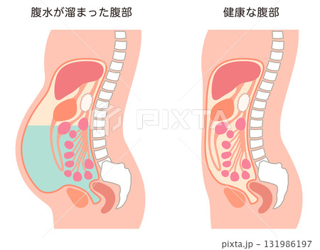 腹水が溜まった腹部と、健康な腹部 131986197