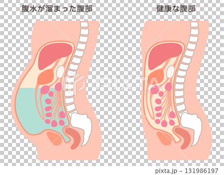 腹水が溜まった腹部と、健康な腹部 131986197