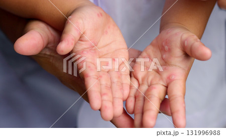 Hand, foot and mouth disease HFMD Human hand of scarlet fever in coxsackievirus palmarosa virus and child hand on white background Hand, foot and mouth disease HFMD Human hand of scarlet fever in coxsackievirus palmarosa virus and child hand on white background 131996988